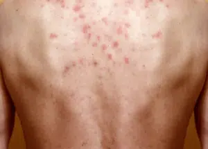 acari del legno punture