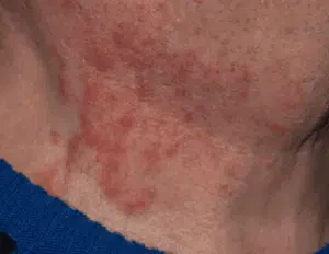 punture di chephalonomia gallicola