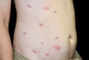 Sclerodermus domesticus puntura